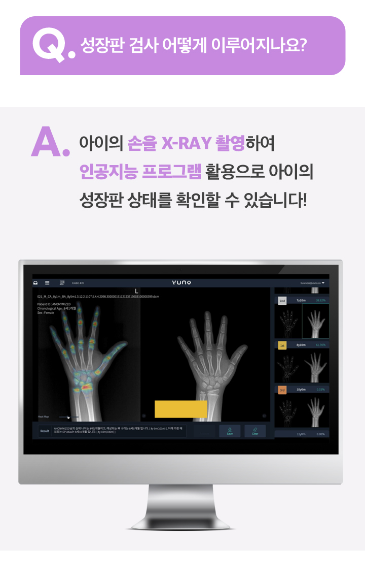 AI 성장판 검사