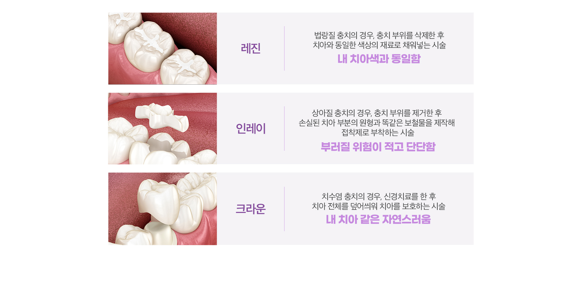 레진/인레이/크라운
