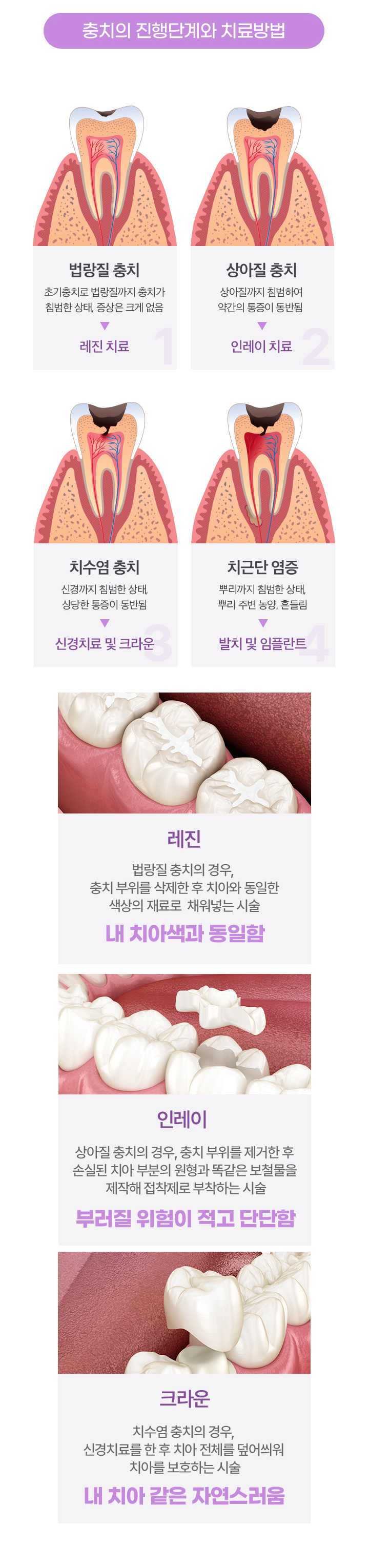 충치의 진행단계와 치료방법